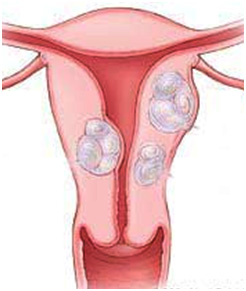 uterus fibroid