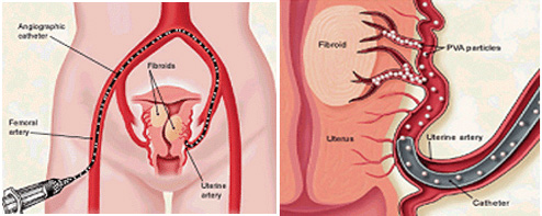 uterus fibroid